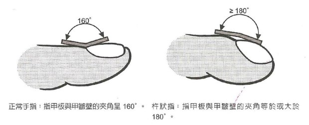 怎樣看出心臟有問題 從手指、舌頭眼神測(cè)試