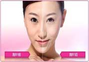 美白針真的有效嗎？美白針的危害有哪些？