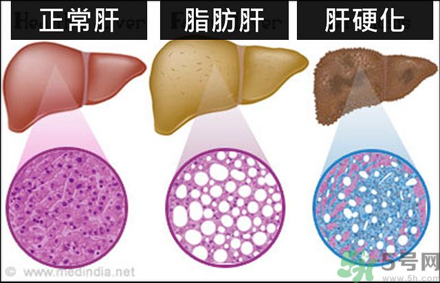 得了脂肪肝該怎么治？脂肪肝對人體危害有多大？