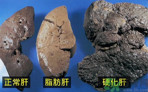 得了脂肪肝該怎么治？脂肪肝對人體危害有多大？