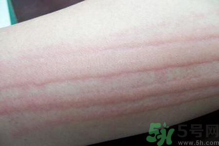蕁麻疹會不會傳染？蕁麻疹怎么治才能好？
