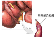 闌尾手術會影響結腸嗎？闌尾手術術后要注意什么？