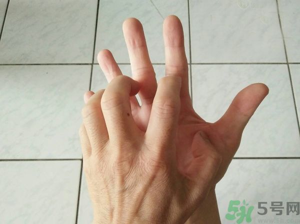 手上起水泡是什么原因？怎樣預防手上起水泡？