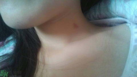 種草莓吻痕是什么意思？吻痕是怎么弄出來的？