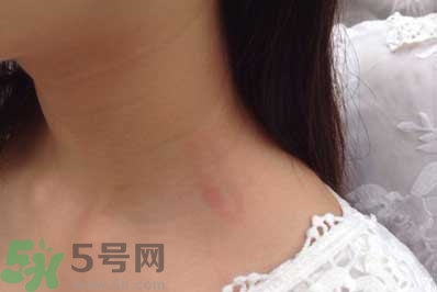種草莓吻痕是什么意思？吻痕是怎么弄出來的？