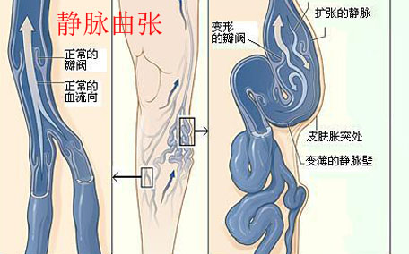 靜脈曲張掛哪個(gè)科就診 靜脈曲張去醫(yī)院做什么檢查