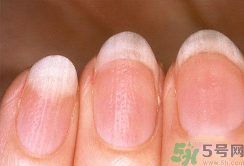 指甲發(fā)白是怎么回事？指甲發(fā)白代表什么？
