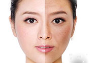激光美白有用嗎？激光美白可以維持多久？
