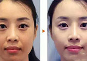 激光美白多少錢？激光美白價(jià)格