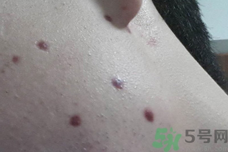 激光點(diǎn)痣后可以洗臉嗎？激光點(diǎn)痣后需要注意什么？