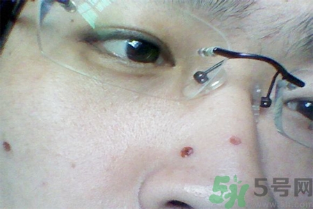 激光點(diǎn)痣后可以洗臉嗎？激光點(diǎn)痣后需要注意什么？