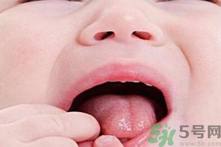 寶寶口腔潰瘍?cè)趺崔k？治療寶寶口腔潰瘍方法有什么？