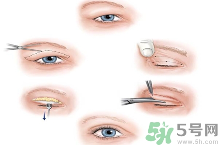割雙眼皮分哪幾種？割雙眼皮需要多少錢？