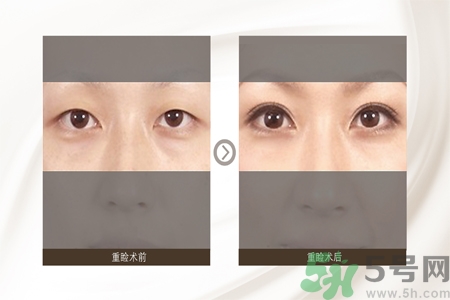 割雙眼皮分哪幾種？割雙眼皮需要多少錢？