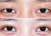 割雙眼皮分哪幾種？割雙眼皮需要多少錢？