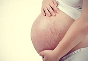 什么是妊娠紋？妊娠紋什么時(shí)候開始長？