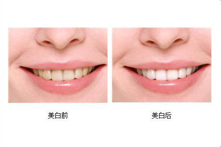 冷光美白牙齒可以保持多長(zhǎng)時(shí)間？冷光美白牙齒有副作用嗎？
