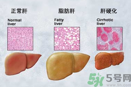 妊娠急性脂肪肝是什么？妊娠急性脂肪肝的治療方法？