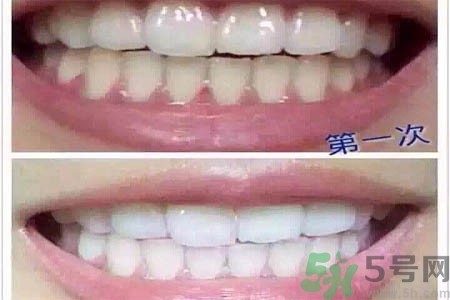 冷光美白牙齒的價格是多少？做冷光美白牙齒需要多少錢？