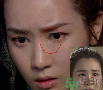 開眼角多少錢？開眼角有什么危害？