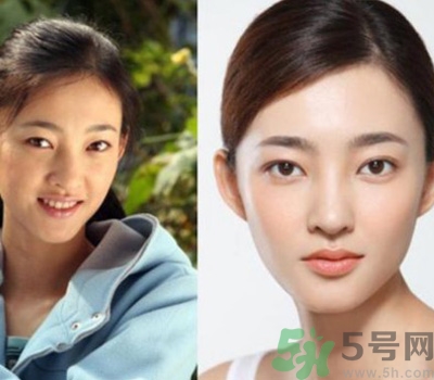 開眼角眼睛會變大嗎？開眼角眼睛能大多少？