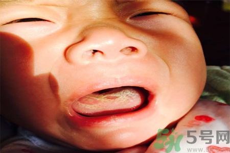 舌頭燙傷后該怎么辦呢？舌頭燙傷后應(yīng)該注意吃什么？?