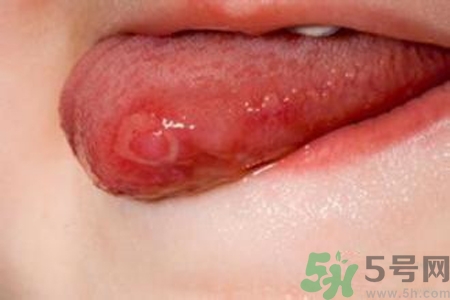 舌頭長泡怎么辦？舌頭長泡的原因？