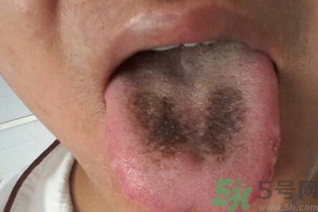 舌頭發(fā)黑怎么回事？舌頭發(fā)黑怎么辦？