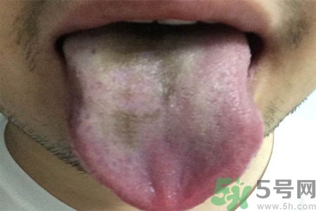 舌頭發(fā)黑怎么回事？舌頭發(fā)黑怎么辦？