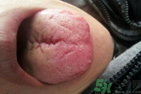 舌頭上有裂紋是怎么辦？舌頭上有裂紋是什么原因？