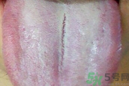 舌頭發(fā)白是什么原因？舌苔發(fā)白是怎么辦？