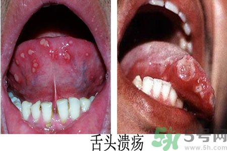 舌頭潰瘍怎么辦？舌頭潰瘍的原因？