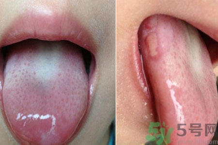 舌頭潰瘍怎么辦？舌頭潰瘍的原因？