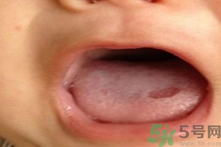 舌頭潰瘍怎么辦？舌頭潰瘍的原因？