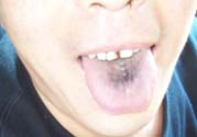 舌頭發(fā)黑怎么回事？舌頭發(fā)黑怎么辦？
