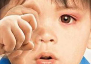 寶寶得了紅眼病怎么辦？寶寶得了紅眼病怎么治？