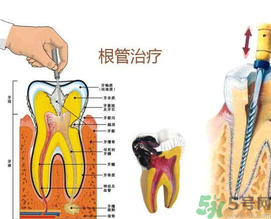 什么是根管治療？為什么牙齒疼要做根管治療？