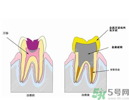 什么是根管治療？為什么牙齒疼要做根管治療？