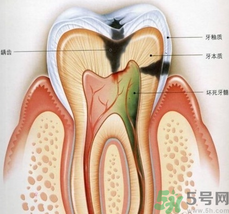 什么是根管治療？為什么牙齒疼要做根管治療？