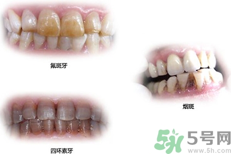 四環(huán)素牙是什么？四環(huán)素牙是怎么形成的？