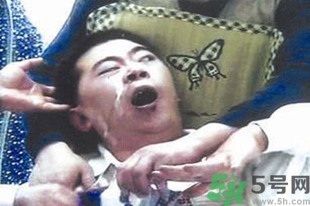 癲癇的典型癥狀有哪些？癲癇是什么？