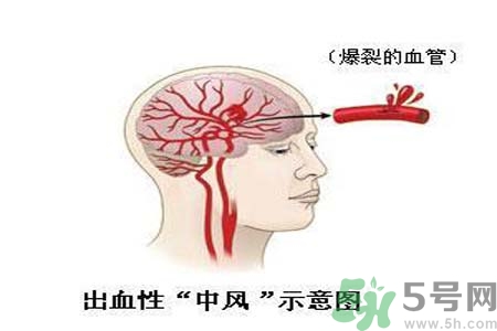腦中風的護理措施？腦中風的飲食護理？