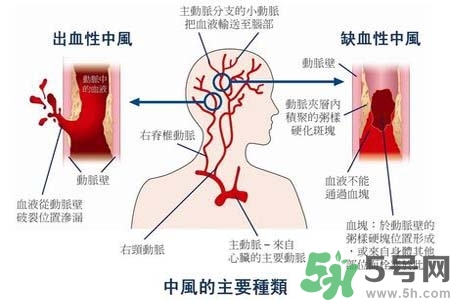 腦中風(fēng)的發(fā)病因素？腦中風(fēng)的并發(fā)癥有哪些 ？