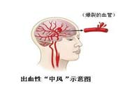 腦中風的發(fā)病因素？腦中風的并發(fā)癥有哪些 ？