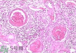 慢性腎炎能治好嗎？慢性腎炎能活多久？