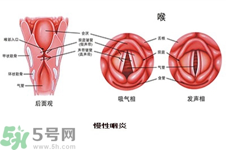 慢性咽炎是什么？慢性咽炎的癥狀有哪些？