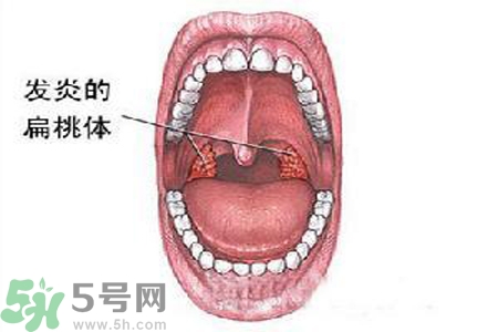 慢性咽炎是什么？慢性咽炎的癥狀有哪些？