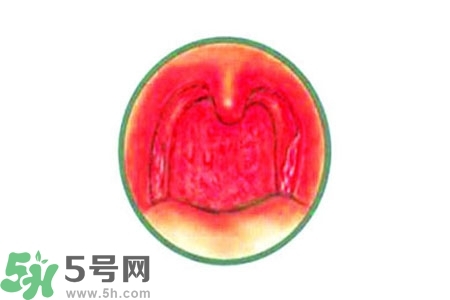 慢性咽炎的治療方法？慢性咽炎的藥物治療？