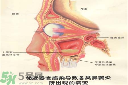 鼻竇炎是什么？鼻竇炎的癥狀有哪些？