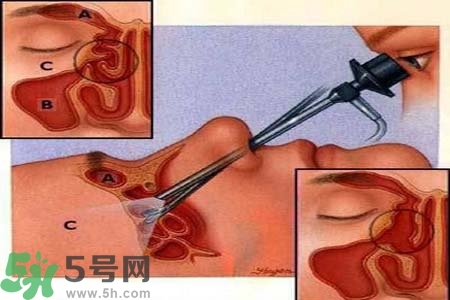 鼻竇炎的高發(fā)人群？如何預(yù)防鼻竇炎？